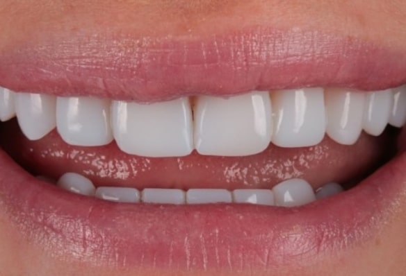 After -Smile Success