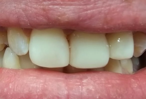 After -Smile Success