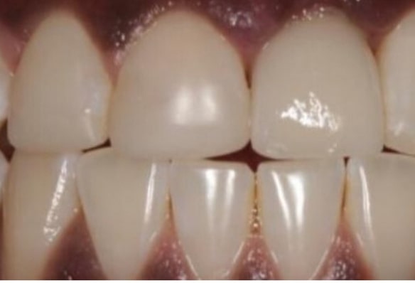 After -Smile Success