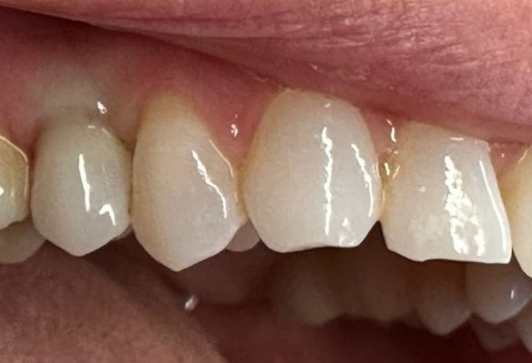 After -Smile Success