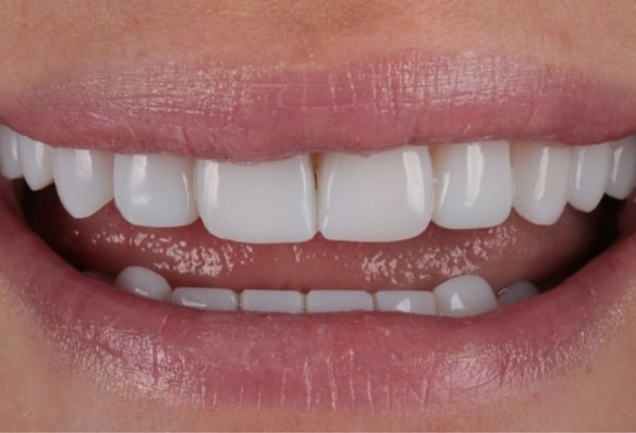 After -Smile Success