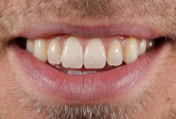 After -Smile Success