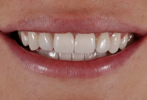 After -Smile Success