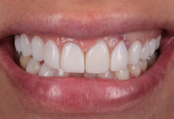 After -Smile Success